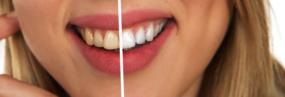 tooth retouch